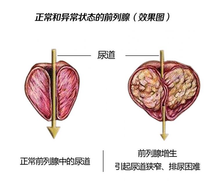 排尿困難、尿不出，很可能是前列腺增生惹的禍